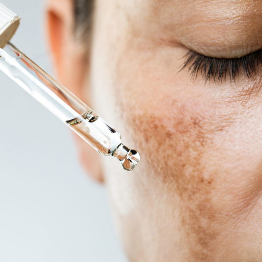 Melasma Treatment Brisbane 